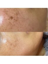 ティーツリー 名古屋 桜山(Tea Tree)/シミケアでこんなにキレイに☆