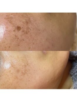 ティーツリー 名古屋 桜山(Tea Tree)/シミケアでこんなにキレイに☆