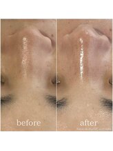 サロン ド ブラン アオヤマ(Salon de BLANC AOYAMA)/ハーブピーリング×ナノ超音波