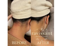 ラヴィソン(ravissant)