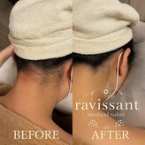 ラヴィソン(ravissant)