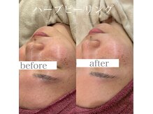 ラフェリ(Rafeli)の雰囲気（ニキビ/ハーブピーリング【施術１回】）