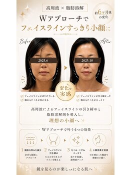 エフリア 大垣(F.lia)/不要な脂肪を燃焼すっきり小顔に