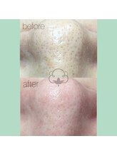 プライベートサロン コットン(COTTON)/毛穴エクストラクション