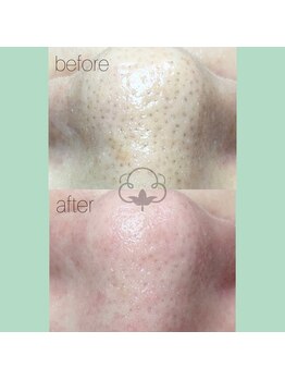 プライベートサロン コットン(COTTON)/毛穴エクストラクション