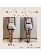 ルシアル(Rucial)/痩身◇ビフォー／アフター