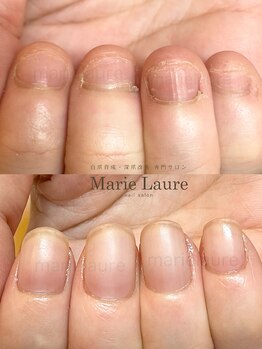 マリーロール 淀屋橋本店(Marie Laure)/自爪育成/深爪矯正/ネイルケア