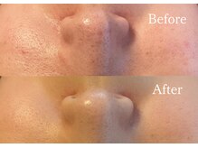 綺麗サロン 脱毛アンドフェイシャル ジュエル(Jewel)/毛穴洗浄×ダイヤモンドピール