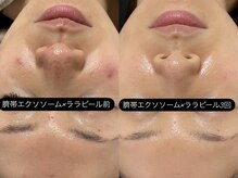グラン ジュテの雰囲気（臍帯エクソソーム×プラピールorララピールで極上艶肌へ）