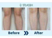 ストラッシュ 立川店(STLASSH)/【ストラッシュ】お客様の施術例