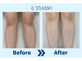 ストラッシュ 立川店(STLASSH)/【ストラッシュ】お客様の施術例