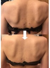 ヴァン ベール 那覇店/背中美肌ケア