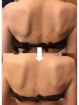 ヴァン ベール 那覇店/背中美肌ケア