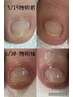 巻き爪モニター親指一本50％off