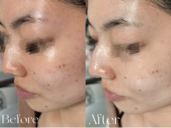 ウィハナ(wehana)/【ララピール】赤み/ニキビ