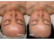 エルピス(ELPIS)/全顔 Wax！