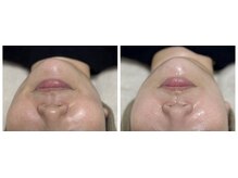 サラン(SALON)/お顔　ビフォーアフター