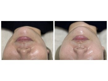 サラン(SALON)/お顔 ビフォーアフター