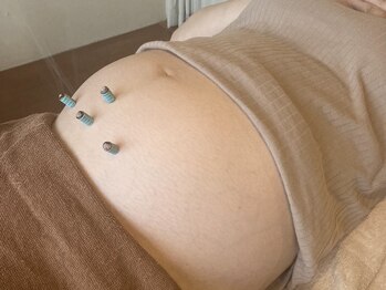 柚香鍼灸院/施術風景　妊活鍼灸