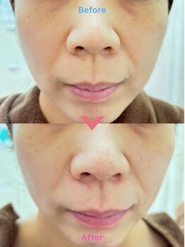 メディカルエステ アンボーテ/winback Tショック