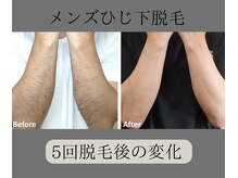 グロワール(gloire)/メンズひじ下脱毛BeforeAfter