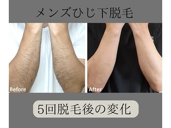 グロワール(gloire)/メンズひじ下脱毛BeforeAfter