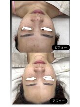 メリアミーゴ(Meli amigo)/20代　ハーブピーリング毛穴洗浄