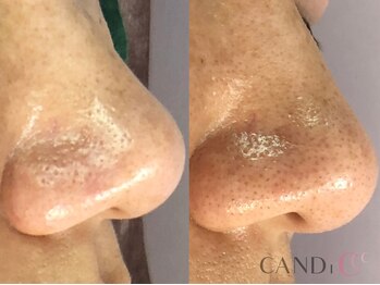 キャンディ 大阪梅田店(CANDi)/ハイドラピーリング/黒ずみ毛穴