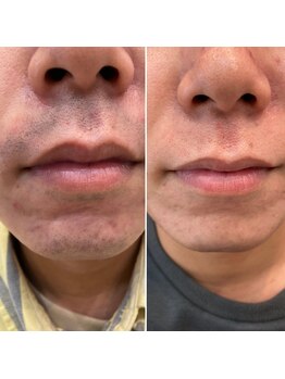 エピシアドットエヌ(epicia.N)/ヒゲ悩みからおさらば