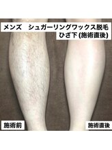 ネイキッドベージュ 恵比寿店(Naked Beige)/メンズワックス脱毛★ビフォアフ