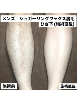 ネイキッドベージュ 恵比寿店(Naked Beige)/メンズワックス脱毛★ビフォアフ