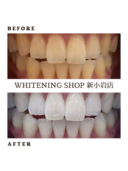 ホワイトニングショップ 新小岩店/歯科提携 ホワイトニング専門店