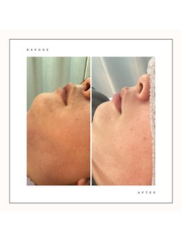 シュエット(Chouette)/メンズ ヒゲ脱毛