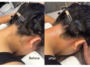 エルピス(ELPIS)/うなじ脱毛