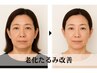 【老化たるみ改善】お顔をキュ！と引き上げ＆艶肌小顔♪17000円→9500円