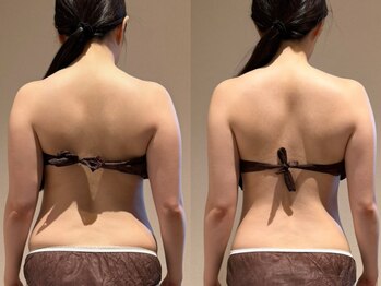 アンティアージュ 福岡本店(antiage)/気になる背中のお肉や肩凝りに