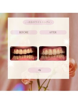 プラスビー 2号店(+b)/ホワイトニングビフォーアフター