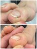 【美容整体】巻き爪矯正1ヶ所(カウンセリング込み)