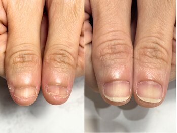 アリエ(allie)/爪の面積があっという間に大きく