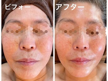 ナオフクオカ ヒーリングフォースエヌ(NaoFukuoka/healingforceN)/70代後半、小顔コルギで小顔艶肌