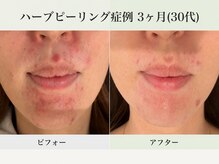 イロドリ(IRODORI)/ハーブピーリング3ヶ月の肌変化