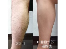 サロンドエーゼット(Salon de AZ)の雰囲気(男性脱毛の一例です。10月末まで、脱毛30%オフ実施中♪)