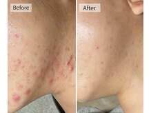 ソアスキン(SOAskin)の雰囲気（大人気の【ハーブピーリング】で肌質改善!ニキビケア・毛穴ケア）