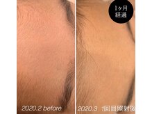 ラディアアンドココサロン(Radia&Coco_salon)/おでこ脱毛ビフォーアフター☆