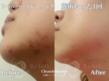 クリーンアンドビューティ 札幌(Clean&Beauty)/ハーブピーリングでニキビケア♪
