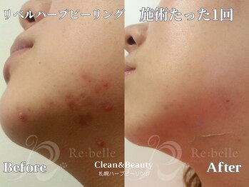 クリーンアンドビューティ 札幌(Clean&Beauty)/ハーブピーリングでニキビケア♪
