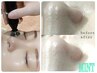 開き毛穴！メラニン毛穴！卒業    【アクアダーマ】¥30,800→¥15,400(50%off)