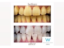 タバコのヤニ汚れやコーヒーなどの着色も綺麗に落ちます★★