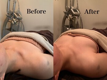 ジェイオー(J.O)/バストアップコルギ/小顔コルギ