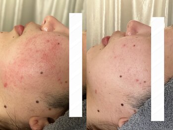 ヨハク(YOHAKU)/プラピール